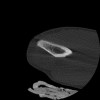 SPORK, NICO - 22.03.1976 - 02.08.2022 - CT obere Extremität - 17:51:17
